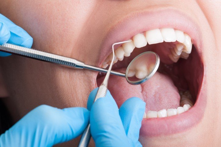 A Cavity: From Birth to Damage | Churchville Dentist