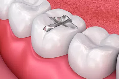 Amalgam Fillings
