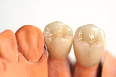 Dental Crowns
