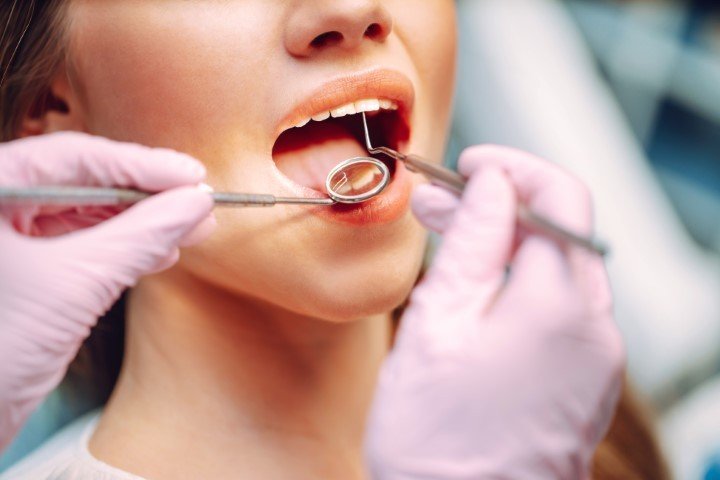 What Are Cavities? A Simple Guide to Understanding Tooth Decay. | Churchville Dentist