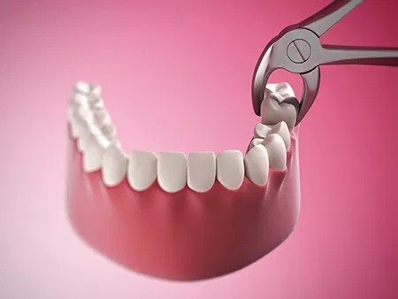 What To Do After Getting A Tooth Taken Out