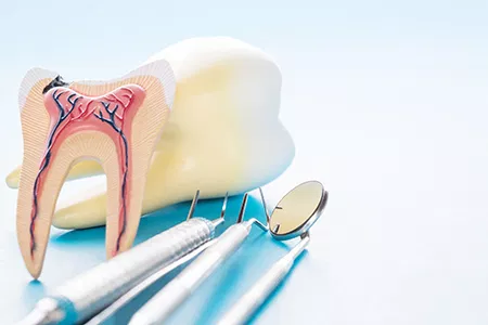 What to expect following root canal treatment